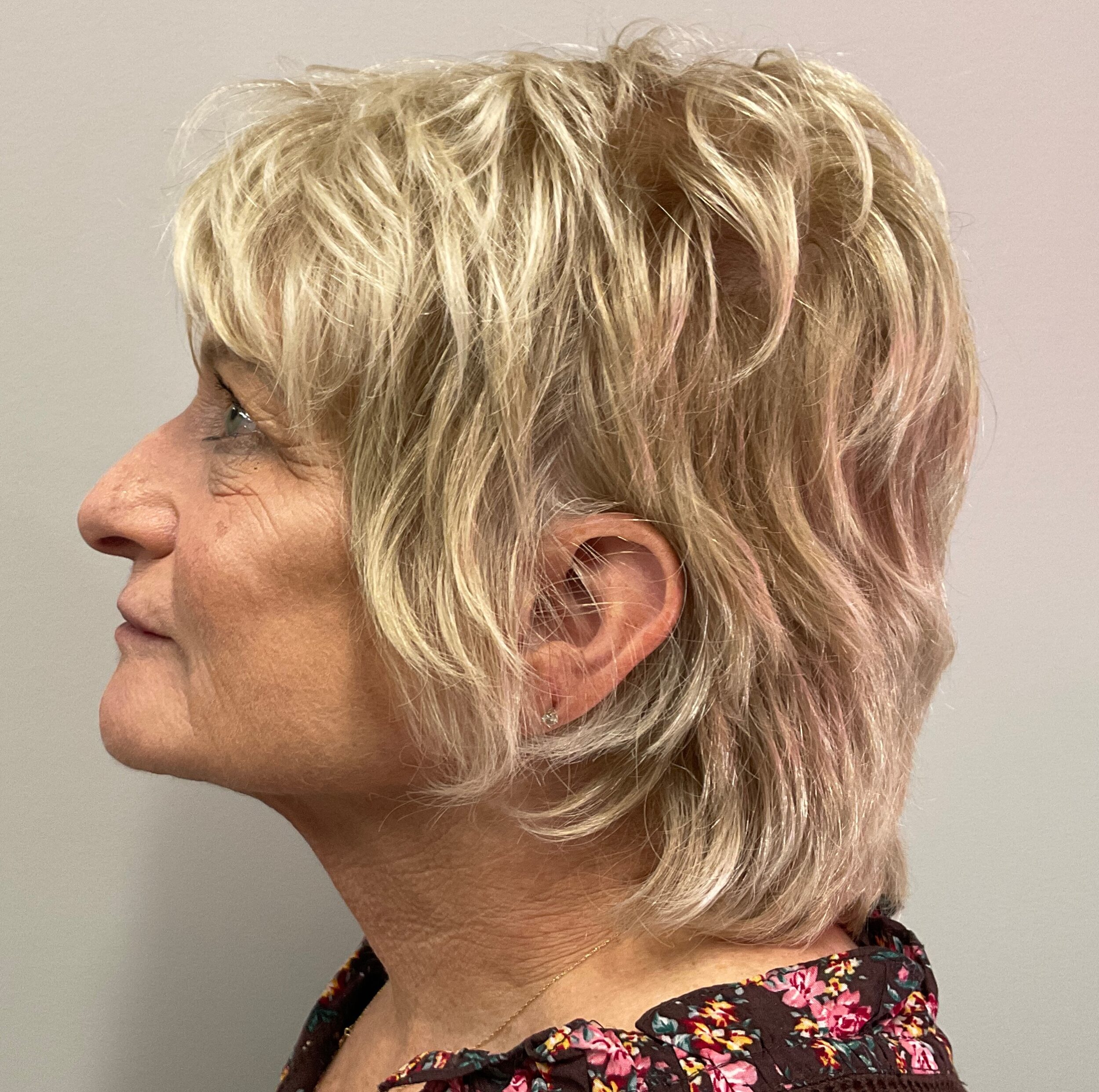 After Image: Dermal Filler – Cheek, Chin, Jaw - left-side