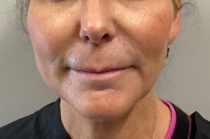 Before Image: Dermal Filler – Volbella (Lips, Smile Lines)