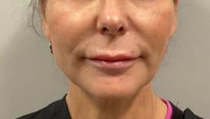 After Image: Dermal Filler – Volbella (Lips, Smile Lines)