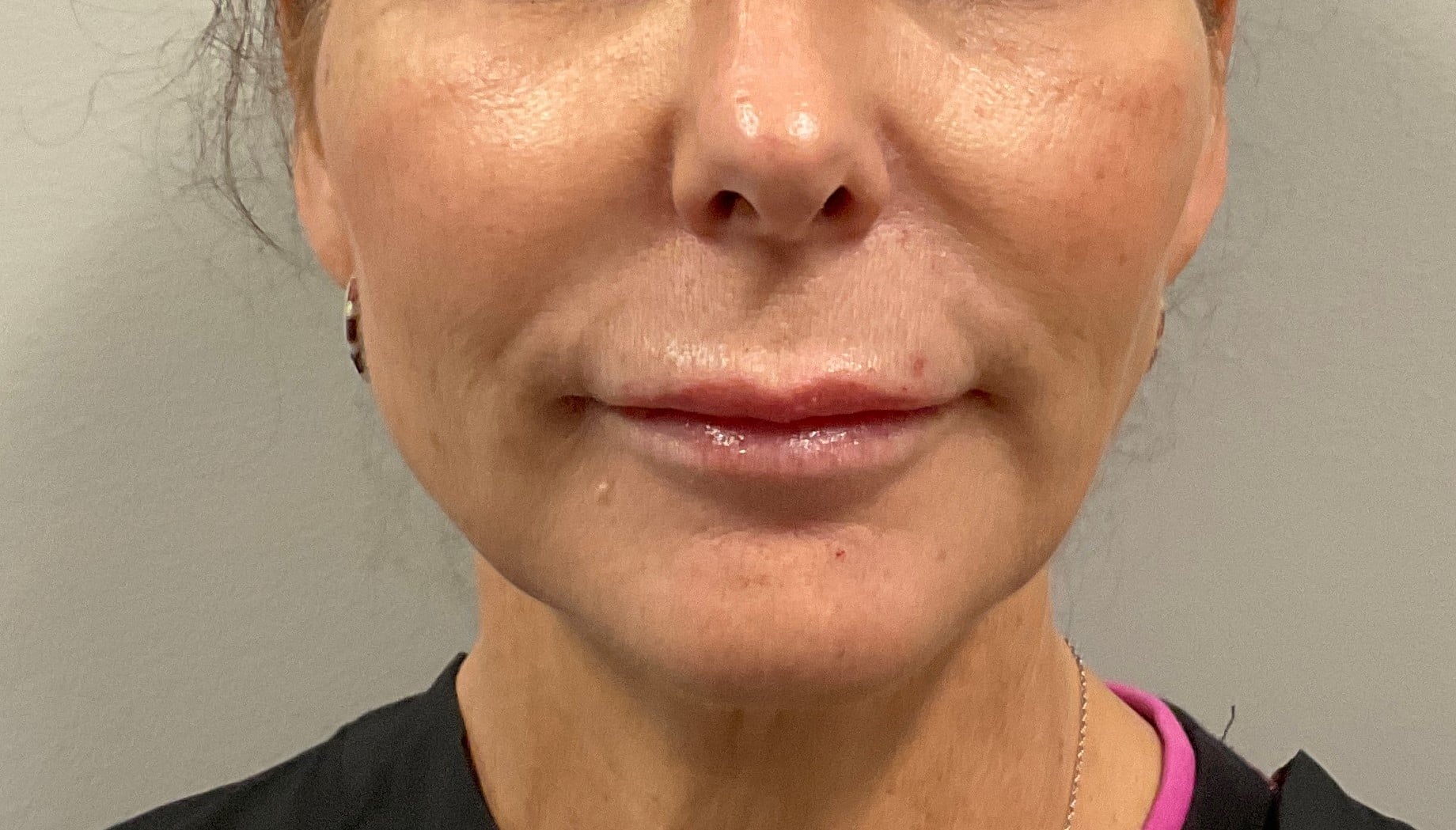 After Image: Dermal Filler – Volbella (Lips, Smile Lines) - front