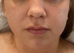 Before Image: Dermal Filler – Lips
