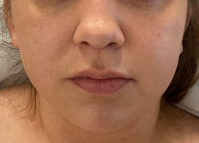 Before Image: Dermal Filler – Lips - front