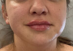 After Image: Dermal Filler – Lips