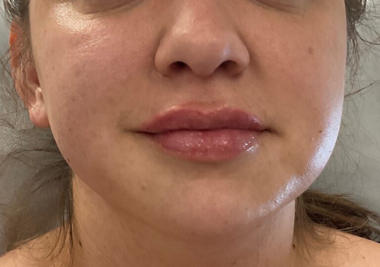 After Image: Dermal Filler – Lips - front
