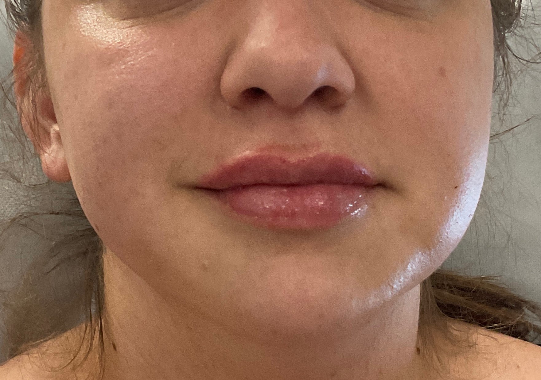 After Image: Dermal Filler – Lips - front