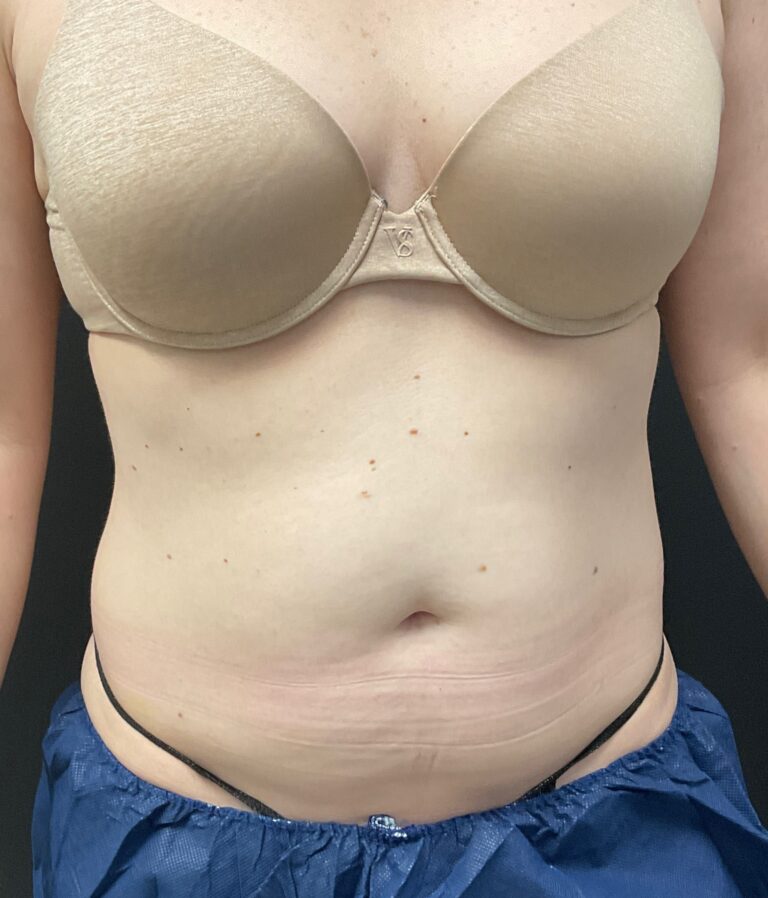 Before Image: CoolSculpting – Abdomen - front