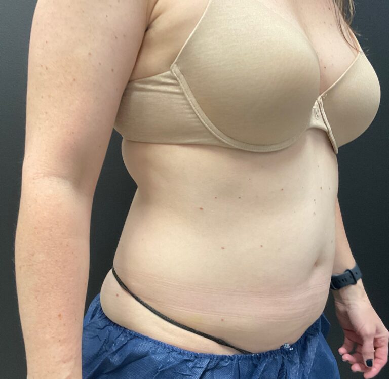 Before Image: CoolSculpting – Abdomen - right-front-oblique