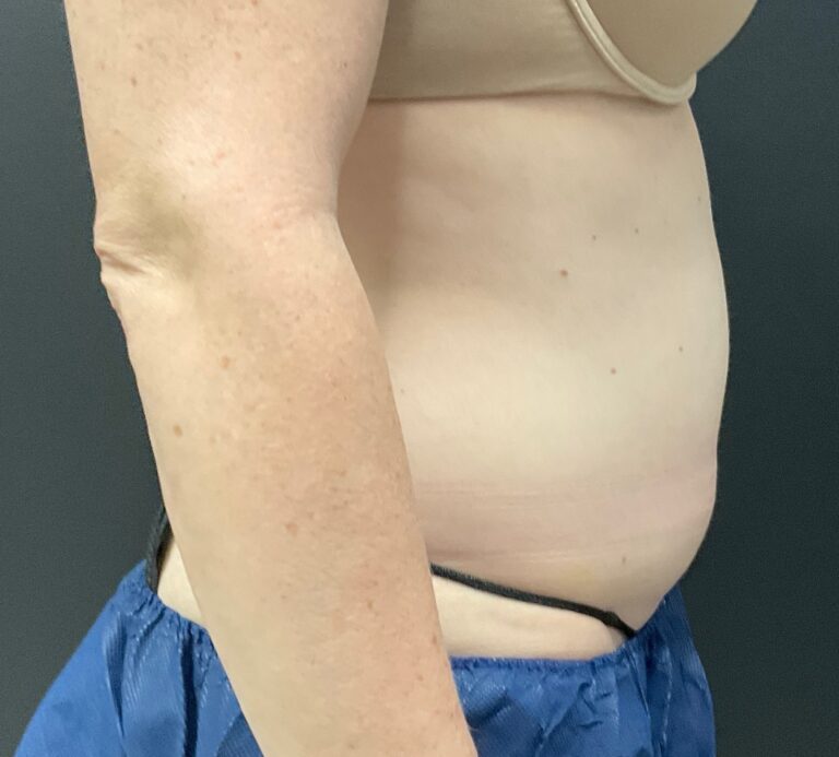 Before Image: CoolSculpting – Abdomen - right-side