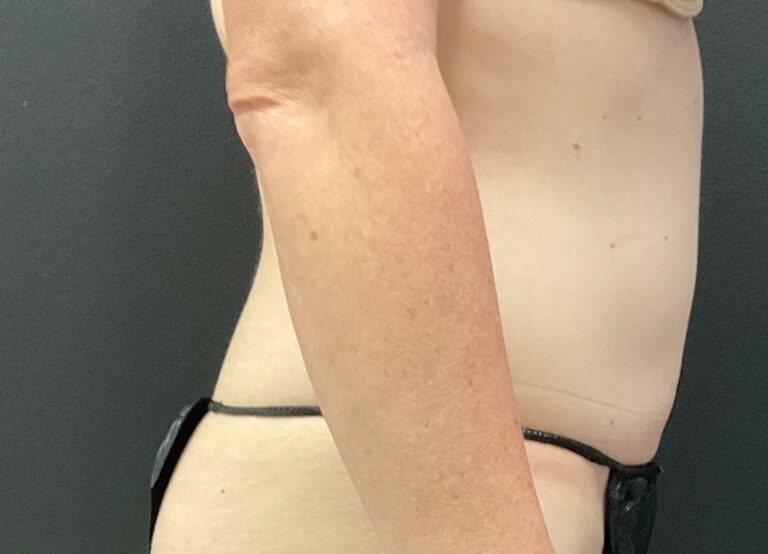 After Image: CoolSculpting – Abdomen - right-side