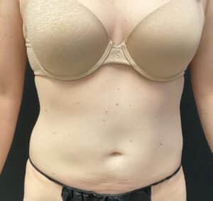 CoolSculpting – Abdomen