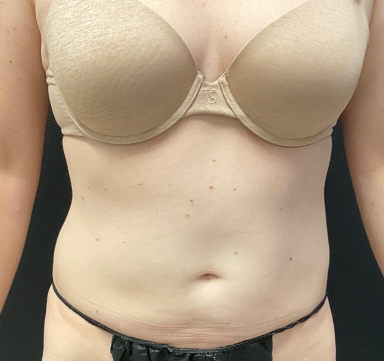 After Image: CoolSculpting – Abdomen - front