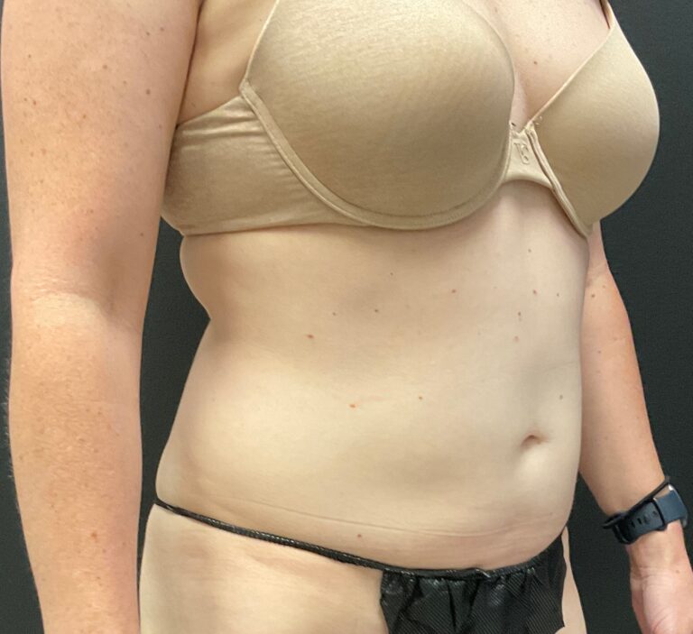After Image: CoolSculpting – Abdomen - right-front-oblique