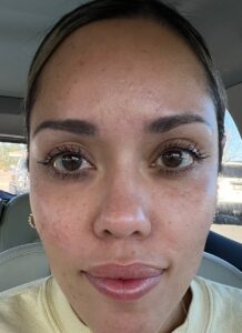 After Image: Dermal Filler – Cheeks and Tear Troughs