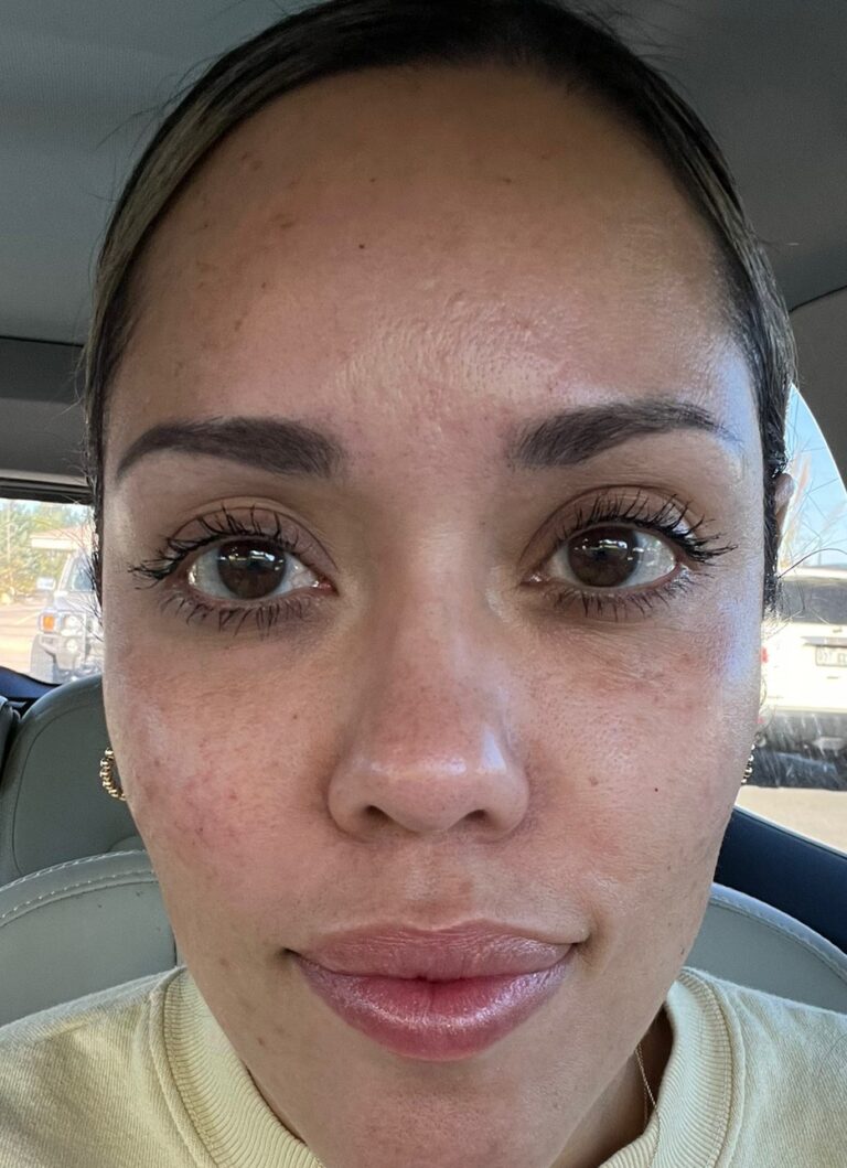 After Image: Dermal Filler – Cheeks and Tear Troughs - front