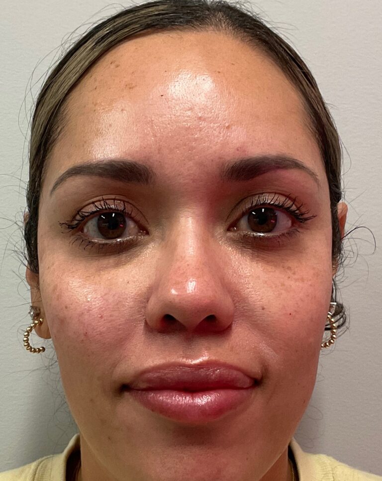 Before Image: Dermal Filler – Cheeks and Tear Troughs - front