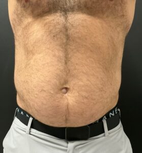 After Image: CoolTone – Abdomen