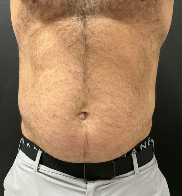 After Image: CoolTone – Abdomen - front