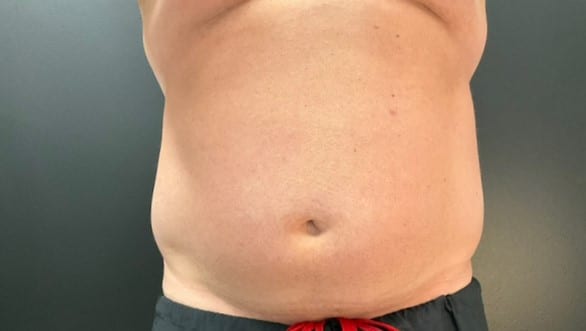 After Image: CoolTone – Abdomen - front