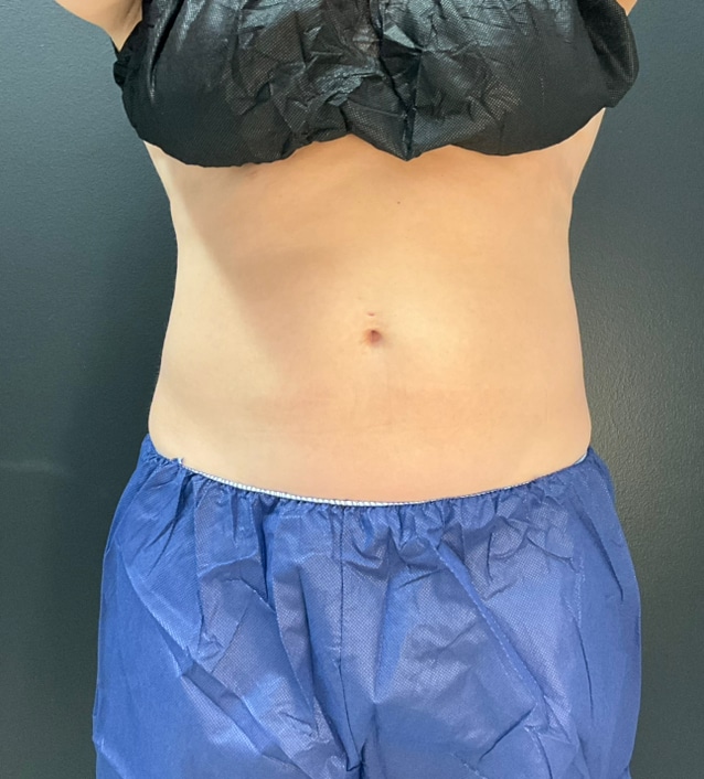 After Image: CoolTone – Abdomen - front