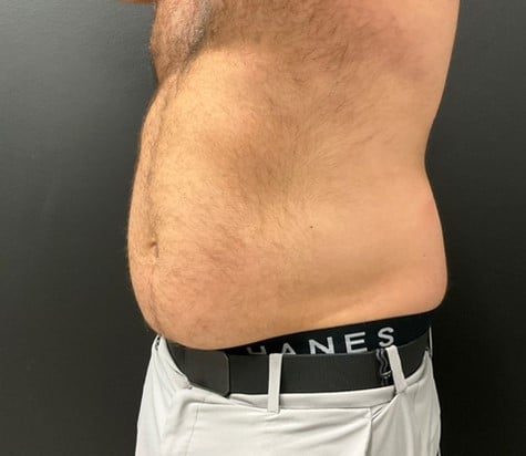 After Image: CoolTone – Abdomen - left-front-oblique