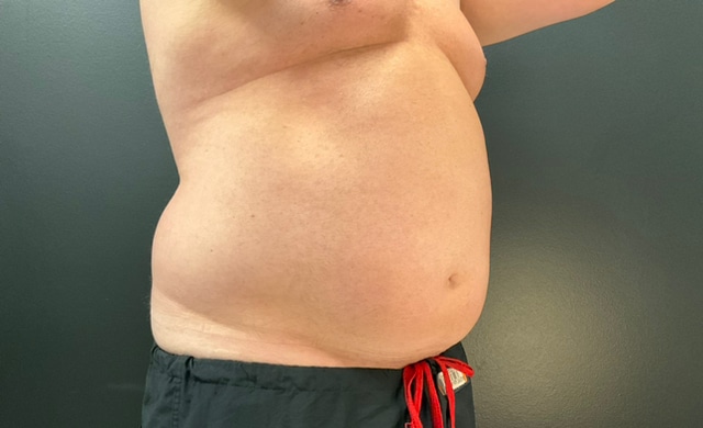 After Image: CoolTone – Abdomen - right-front-oblique