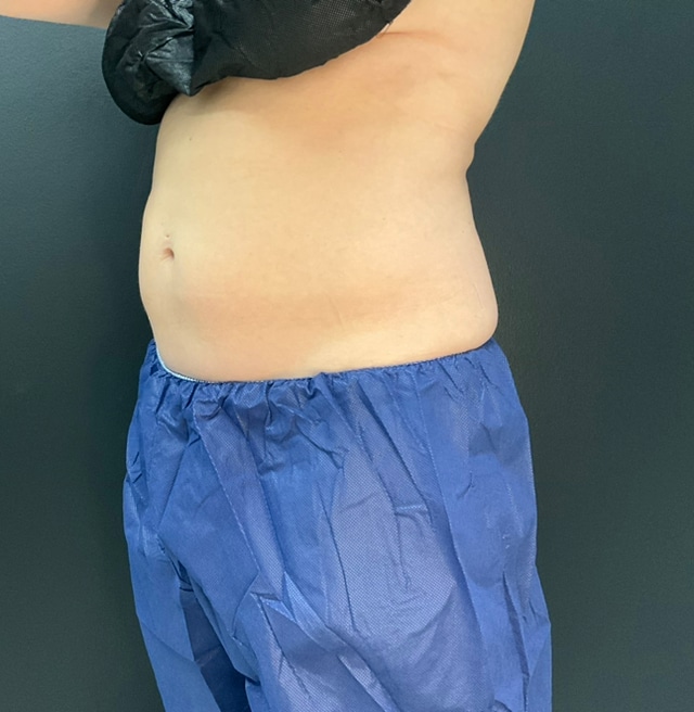 After Image: CoolTone – Abdomen - left-front-oblique