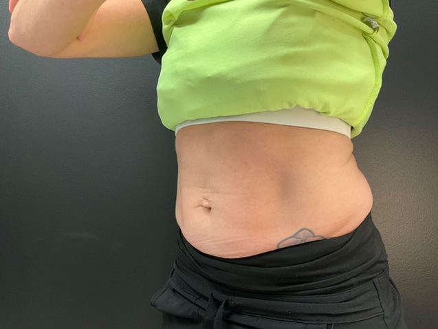 After Image: CoolTone – Abdomen - left-front-oblique