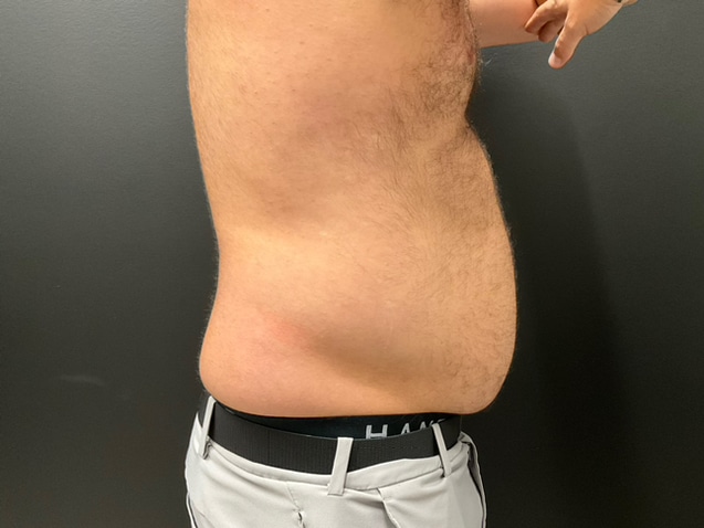 After Image: CoolTone – Abdomen - right-side