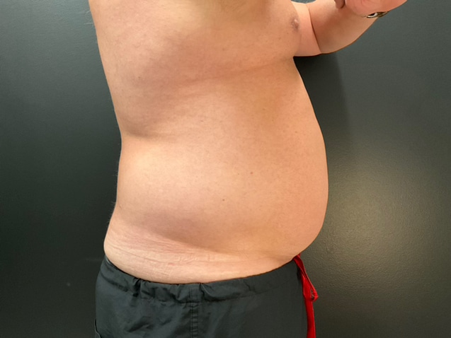 After Image: CoolTone – Abdomen - right-side