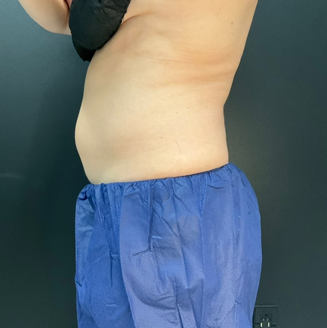 After Image: CoolTone – Abdomen - left-side