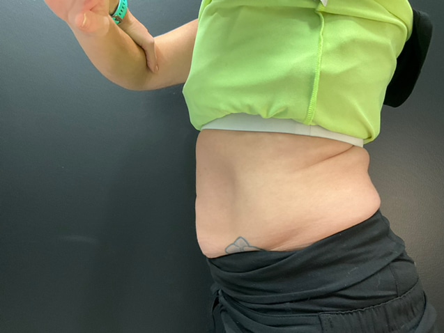 After Image: CoolTone – Abdomen - left-side