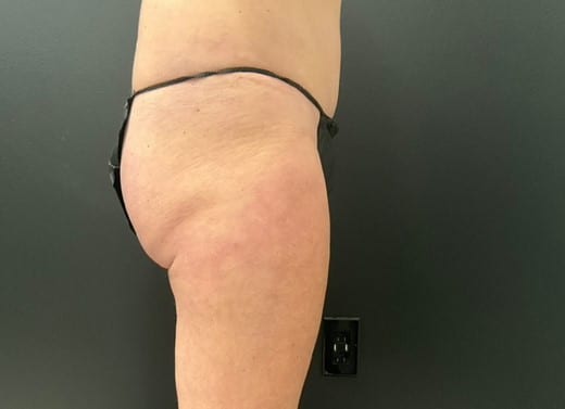 After Image: CoolTone – Glutes & Abdomen - right-side