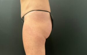 After Image: CoolTone – Glutes & Abdomen