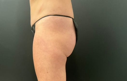 After Image: CoolTone – Glutes & Abdomen - left-side