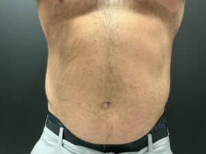 Before Image: CoolTone – Abdomen