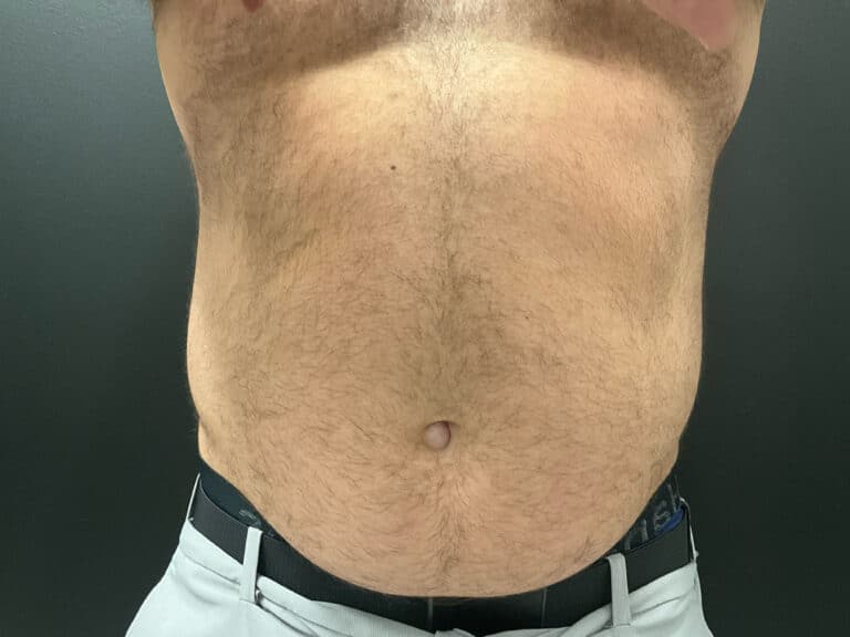 Before Image: CoolTone – Abdomen - front