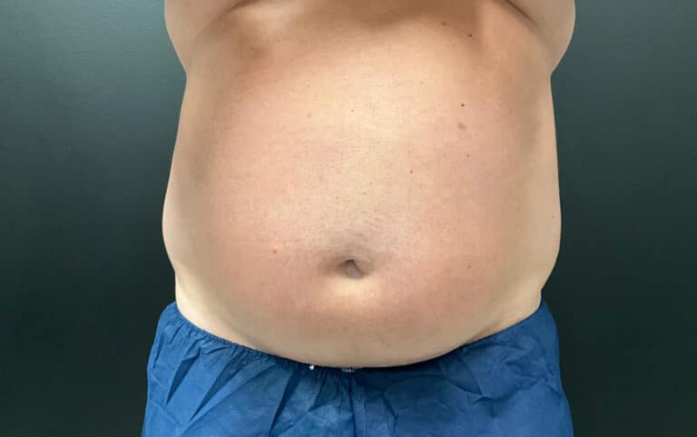 Before Image: CoolTone – Abdomen - front