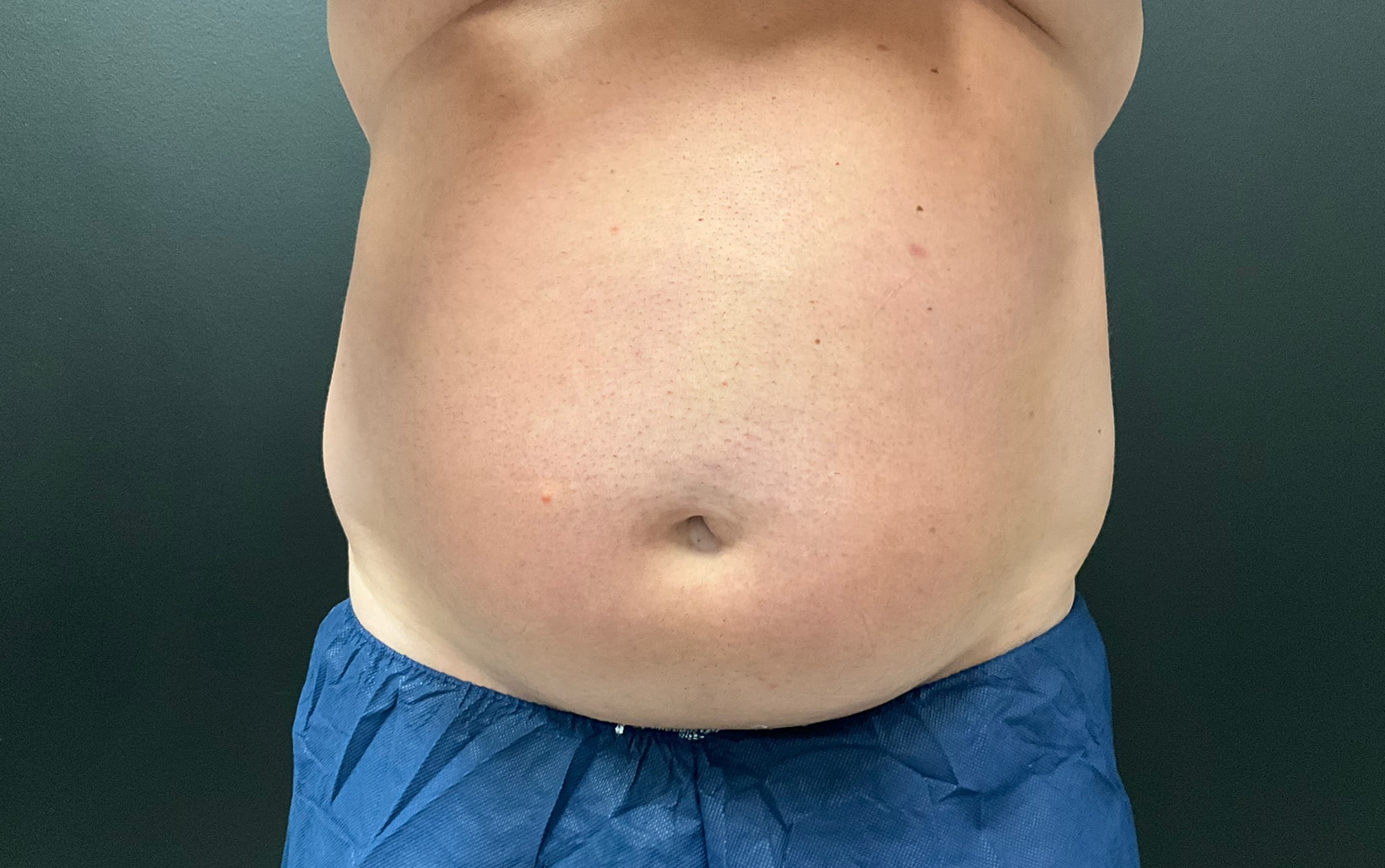 Before Image: CoolTone – Abdomen - front