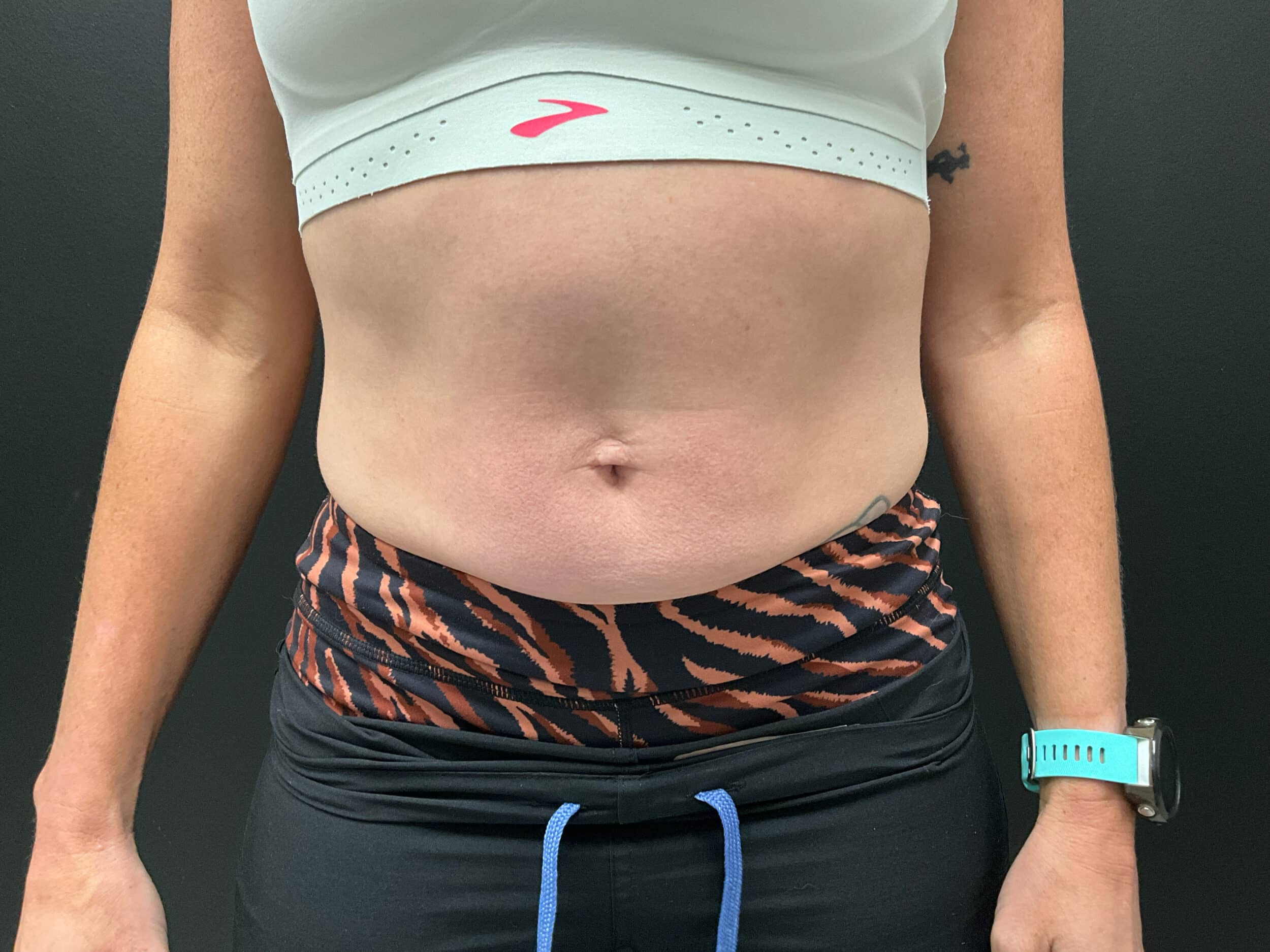 Before Image: CoolTone – Abdomen - right-front-oblique
