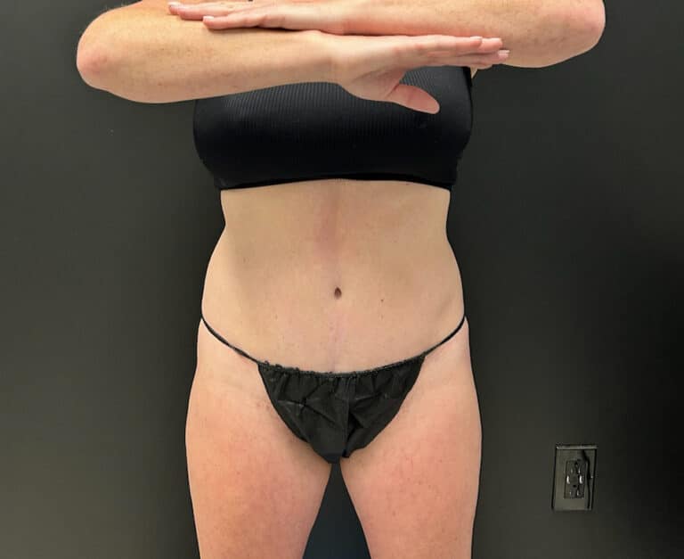 Before Image: CoolTone – Glutes & Abdomen - front