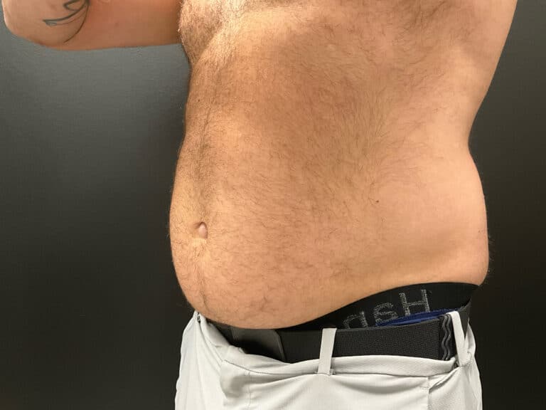 Before Image: CoolTone – Abdomen - left-front-oblique