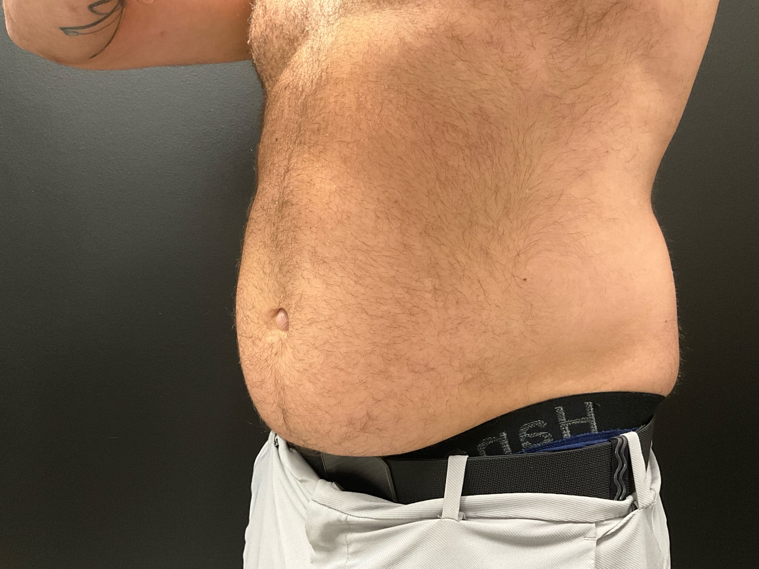 Before Image: CoolTone – Abdomen - left-front-oblique