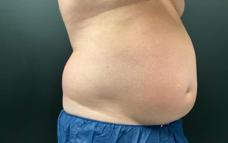 Before Image: CoolTone – Abdomen - right-front-oblique