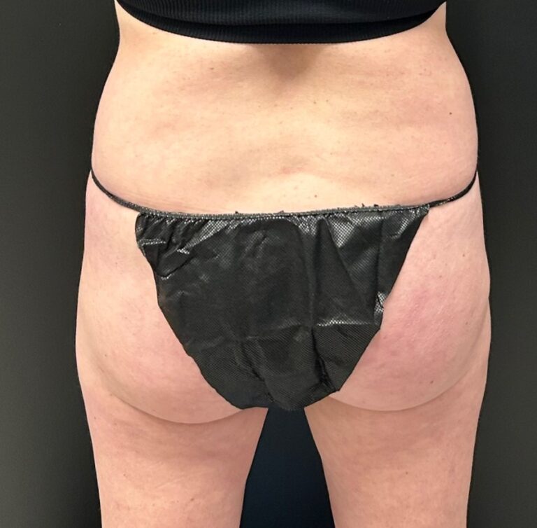 Before Image: CoolTone – Glutes & Abdomen - back