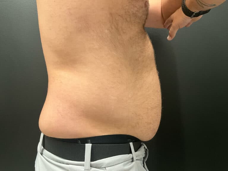Before Image: CoolTone – Abdomen - right-side