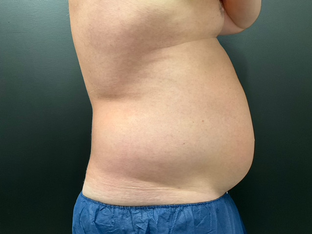 Before Image: CoolTone – Abdomen - right-side