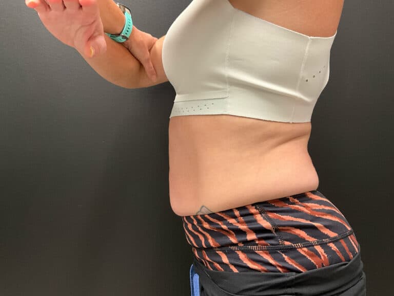 Before Image: CoolTone – Abdomen - left-side