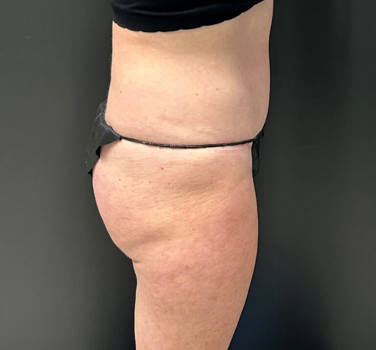 Before Image: CoolTone – Glutes & Abdomen - right-side