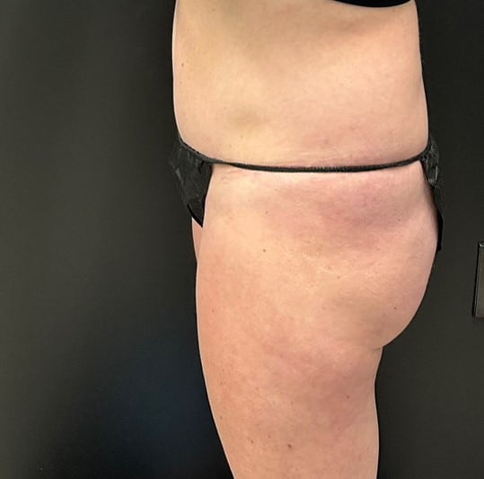 Before Image: CoolTone – Glutes & Abdomen - left-side