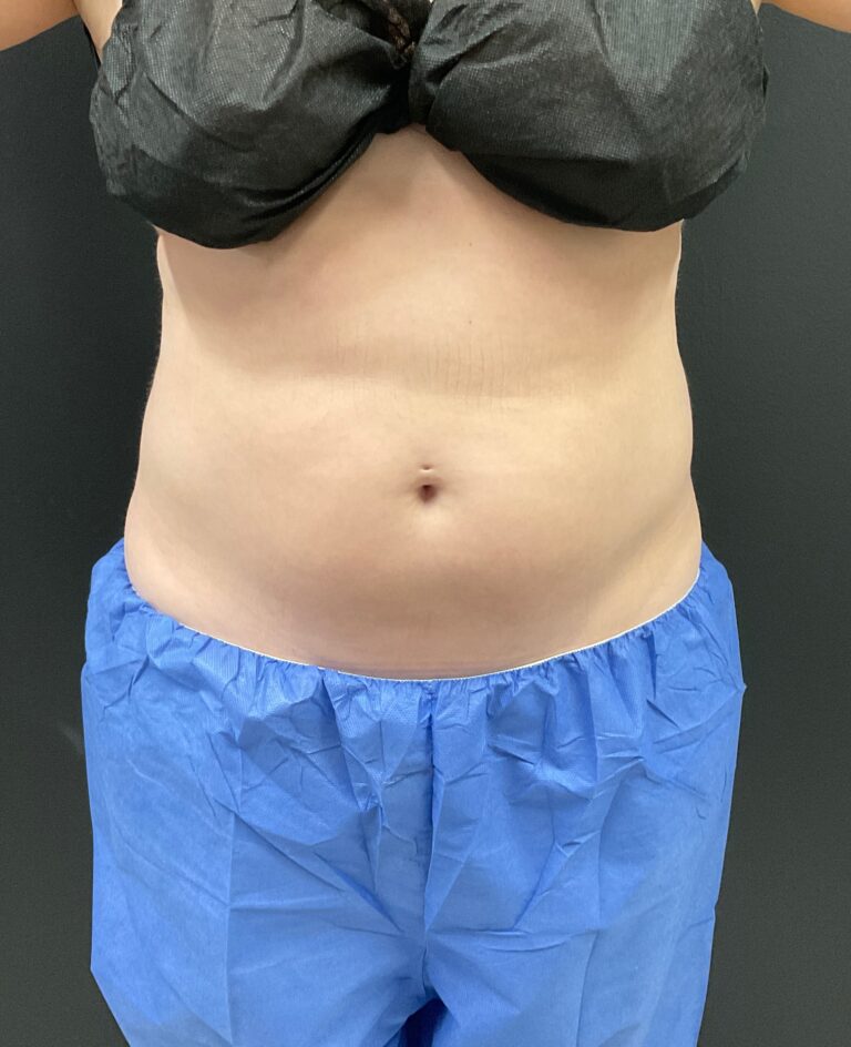 Before Image: CoolTone – Abdomen - front